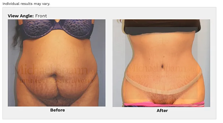 Before and after body transformation comparison image.