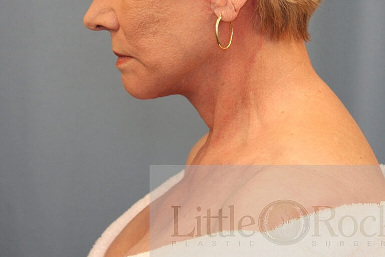 Neck Lift Before & After