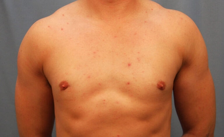Gynecomastia Before & After