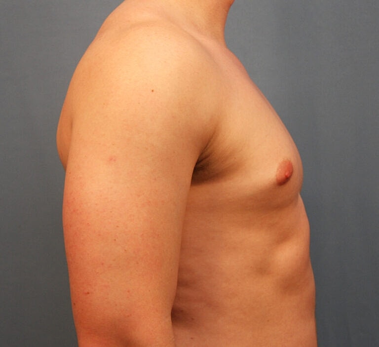 Gynecomastia Before & After