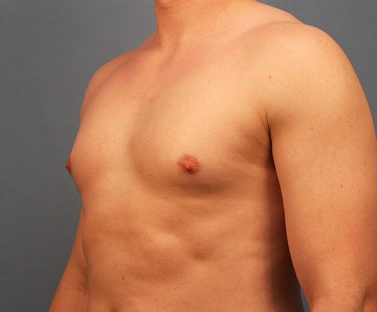 Gynecomastia Before & After