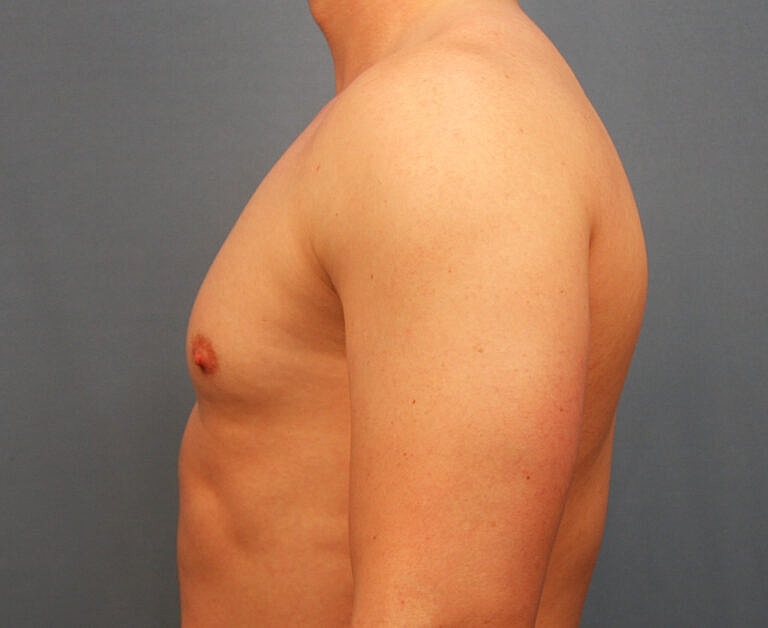 Gynecomastia Before & After