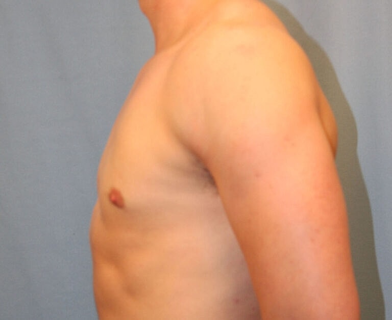 Gynecomastia Before & After