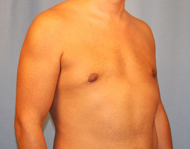 Gynecomastia Before & After