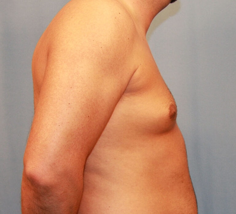 Gynecomastia Before & After