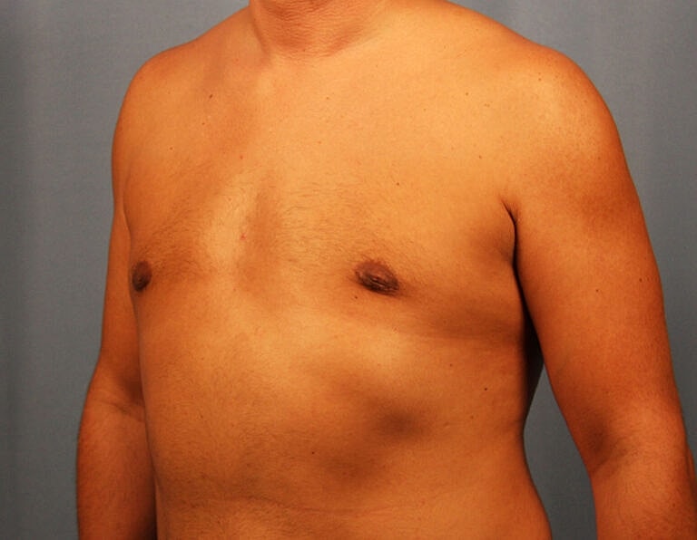 Gynecomastia Before & After