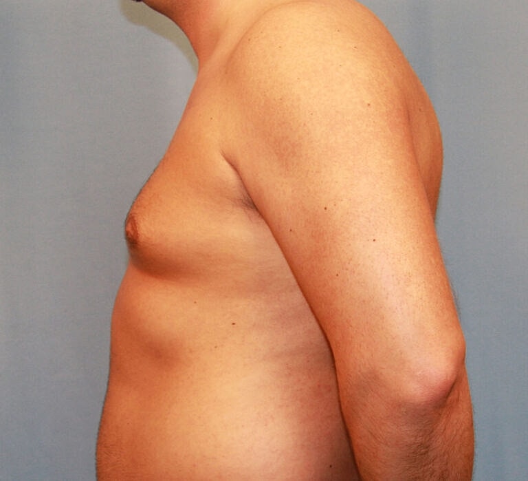 Gynecomastia Before & After
