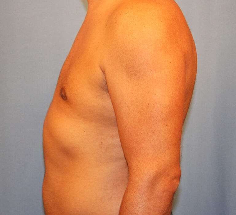 Gynecomastia Before & After