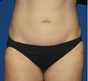 Before & After Gallery Liposuction Before & After
