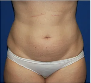 Before & After Gallery Liposuction Before & After