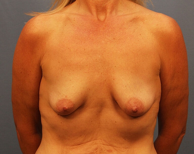 Breast Lift Before & After