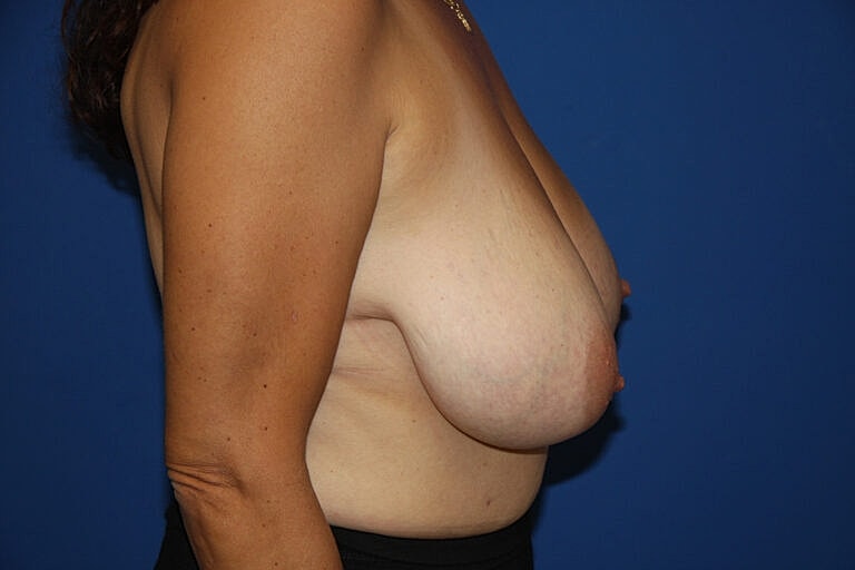 Breast Lift Before & After
