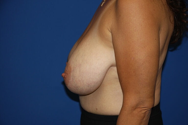 Breast Lift Before & After