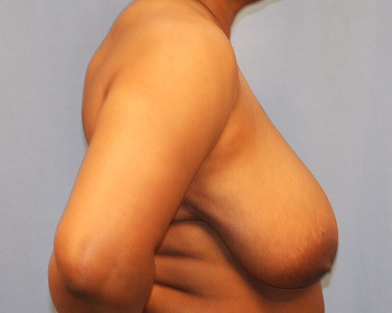 Breast Reduction Before & After