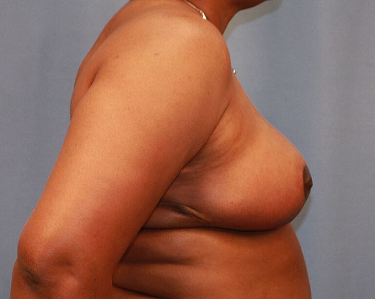 Breast Reduction Before & After