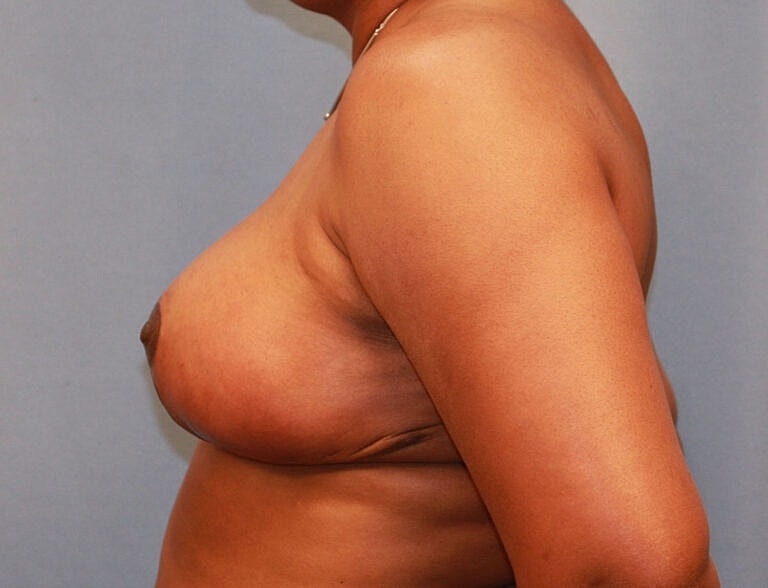 Breast Reduction Before & After