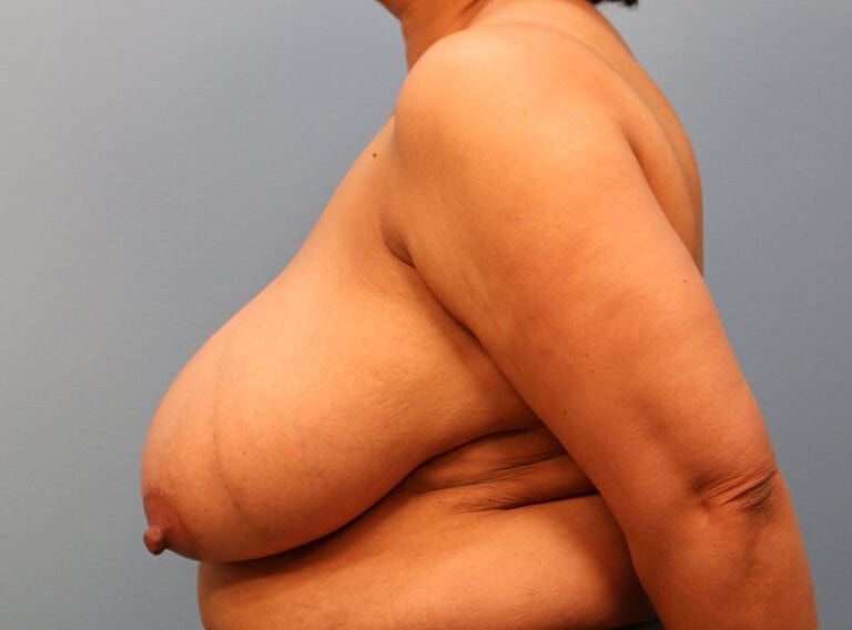 Breast Reduction Before & After