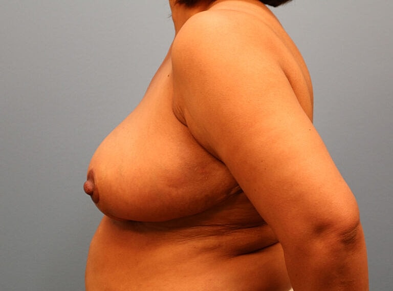Breast Reduction Before & After