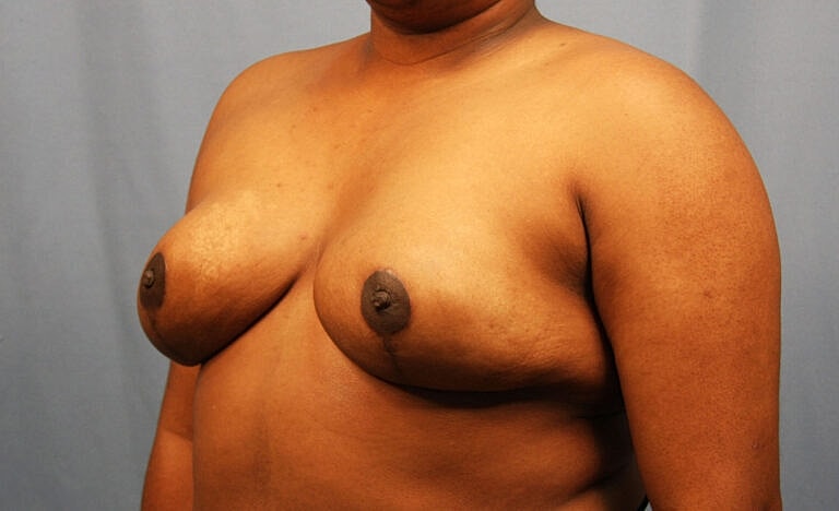 Breast Reduction Before & After