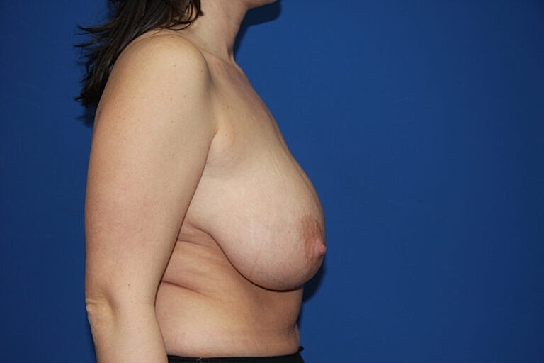 Breast Reduction Before & After