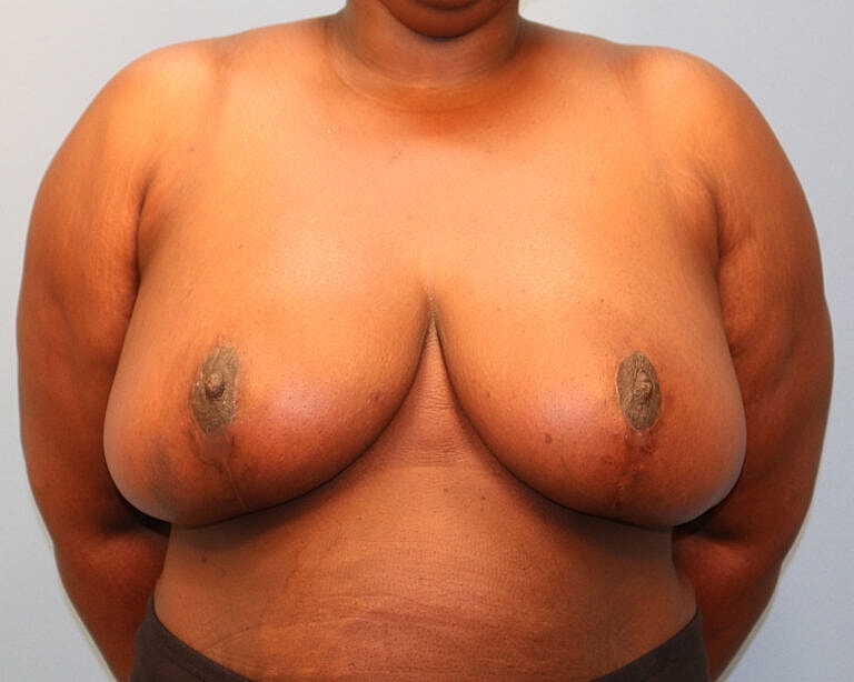 Breast Reduction Before & After