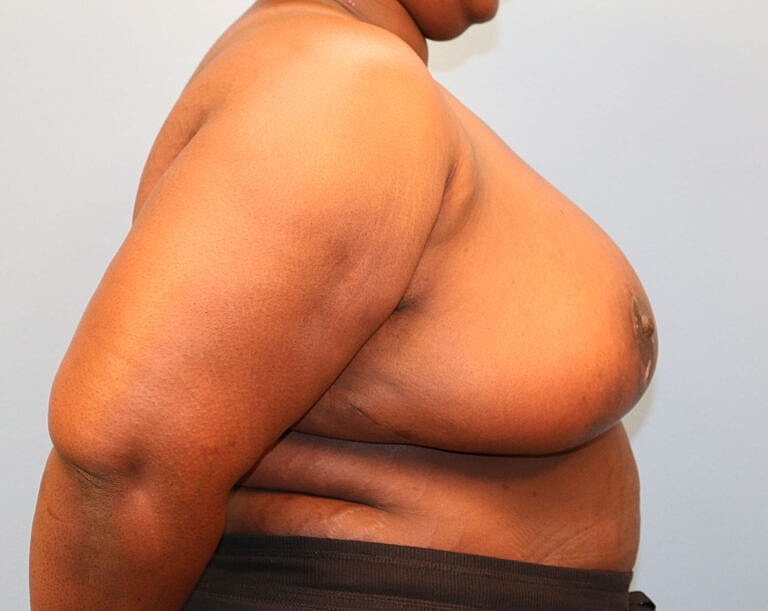 Breast Reduction Before & After