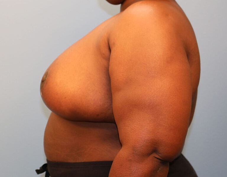 Breast Reduction Before & After