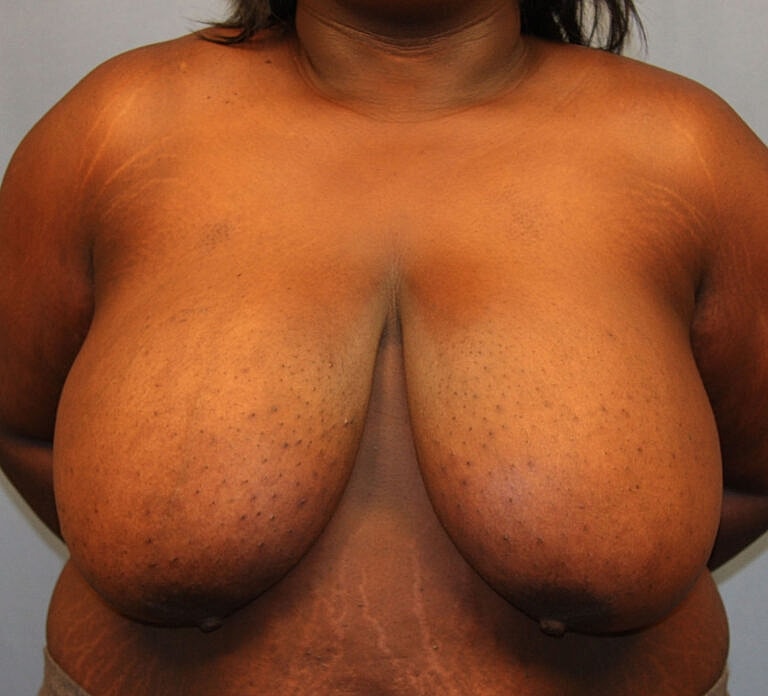 Breast Reduction Before & After