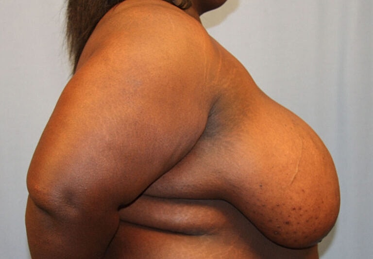 Breast Reduction Before & After