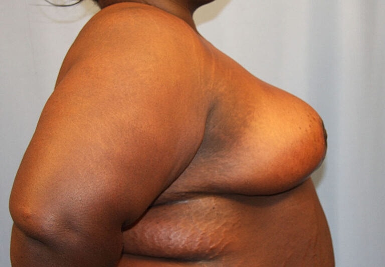 Breast Reduction Before & After