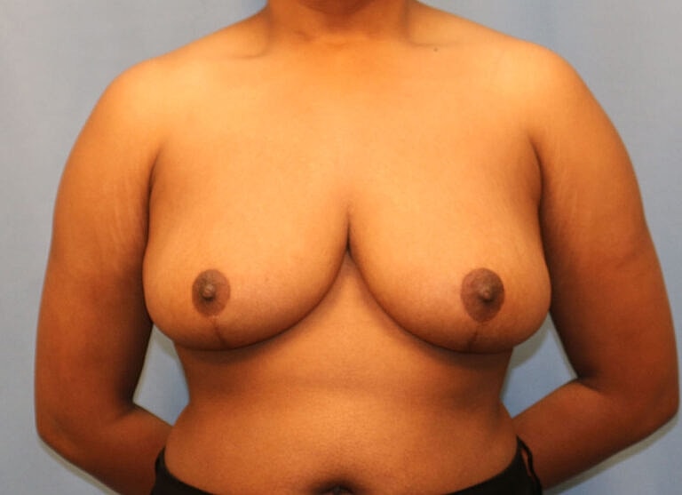 Breast Reduction Before & After
