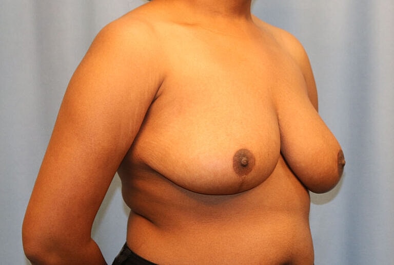 Breast Reduction Before & After