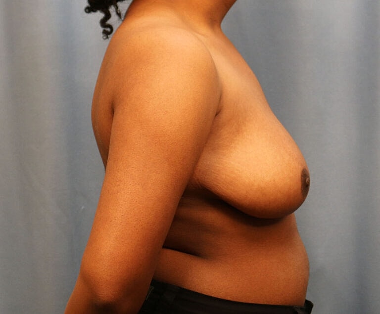 Breast Reduction Before & After