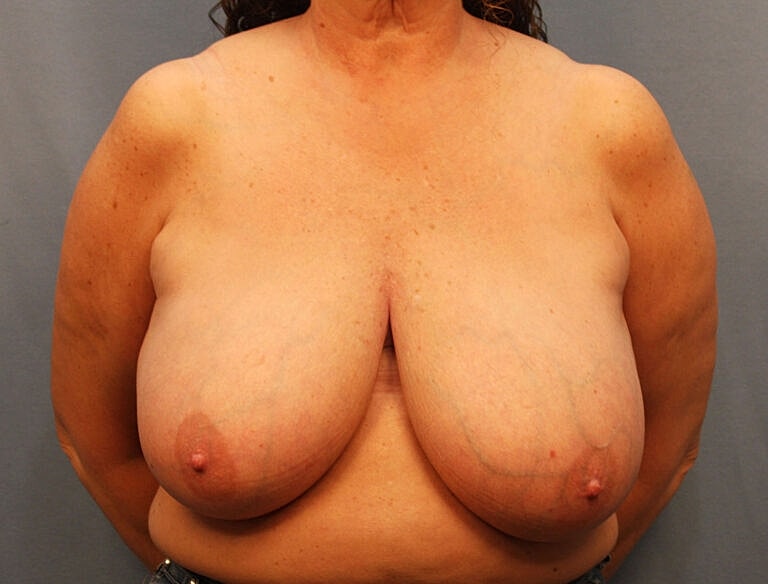 Breast Reduction Before & After