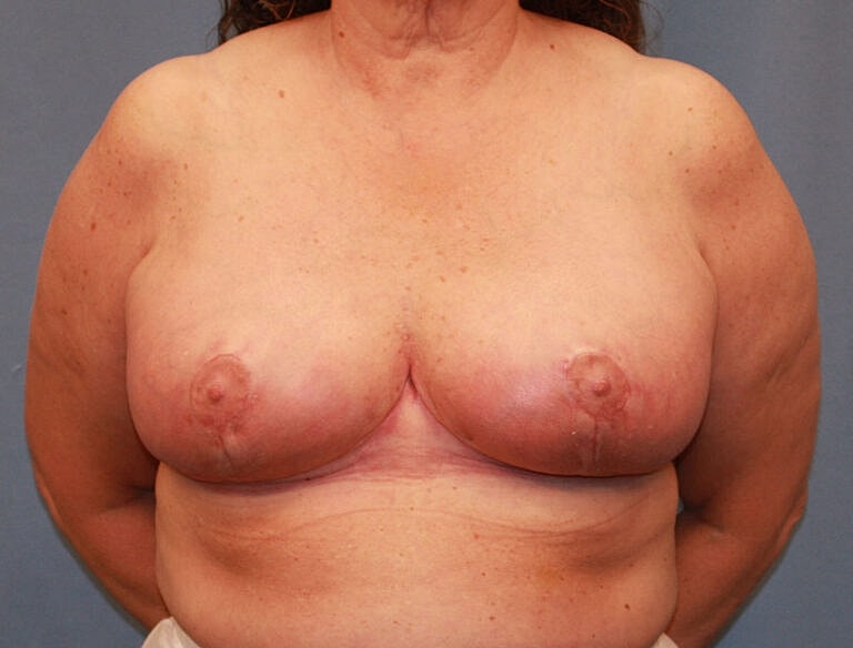 Breast Reduction Before & After