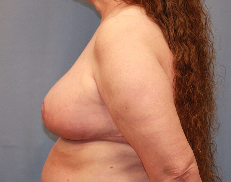 Breast Reduction Before & After