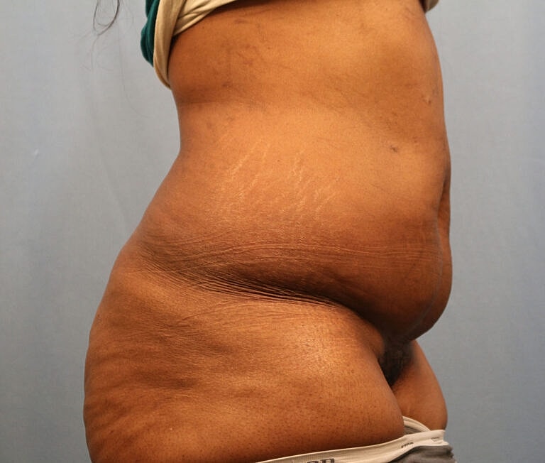 Abdominoplasty Tummy Tuck Before & After