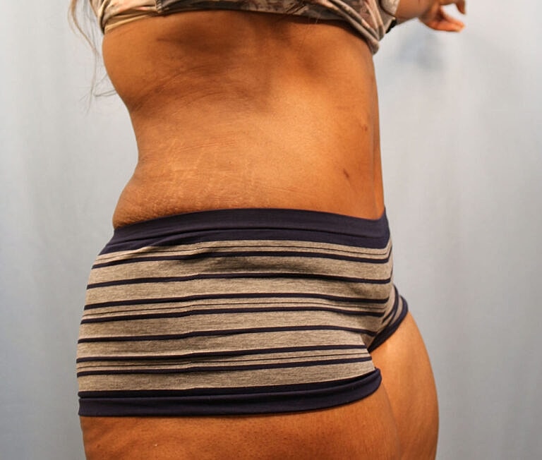 Abdominoplasty Tummy Tuck Before & After