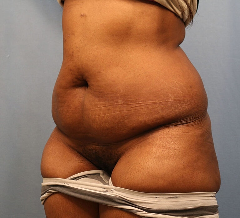Abdominoplasty Tummy Tuck Before & After