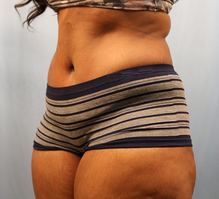 Abdominoplasty Tummy Tuck Before & After