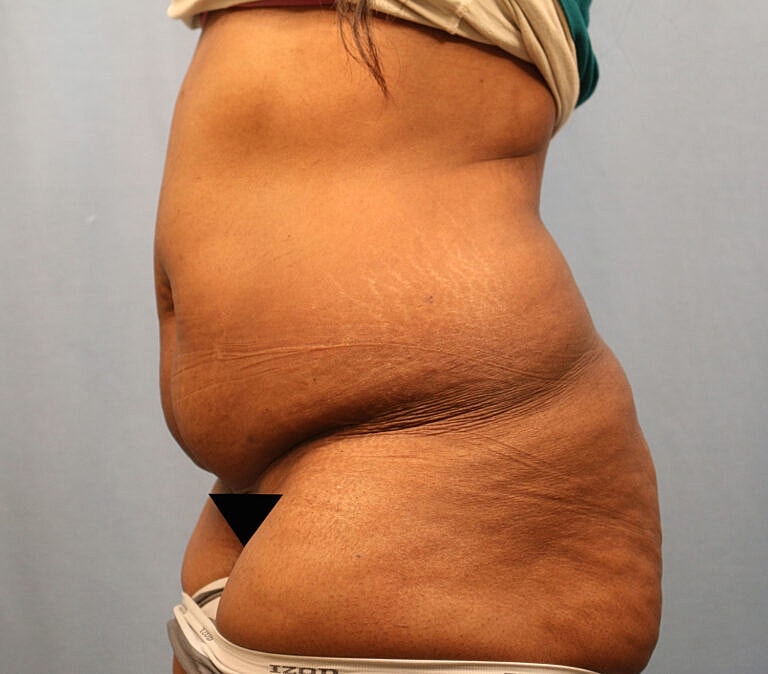 Abdominoplasty Tummy Tuck Before & After