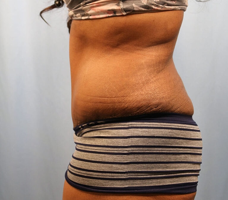 Abdominoplasty Tummy Tuck Before & After