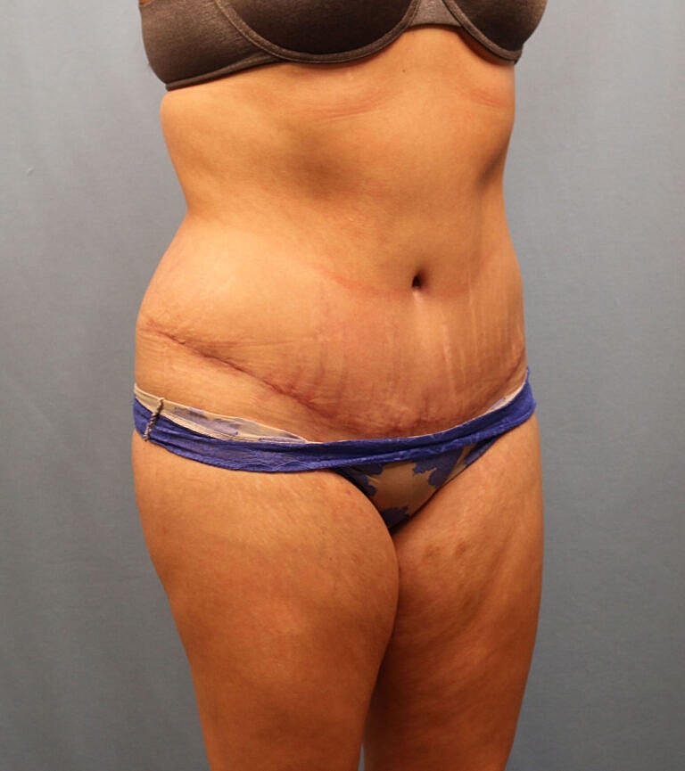 Abdominoplasty Tummy Tuck Before & After