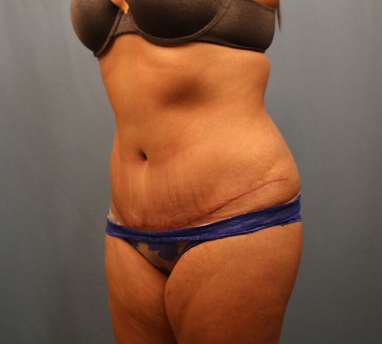 Abdominoplasty Tummy Tuck Before & After