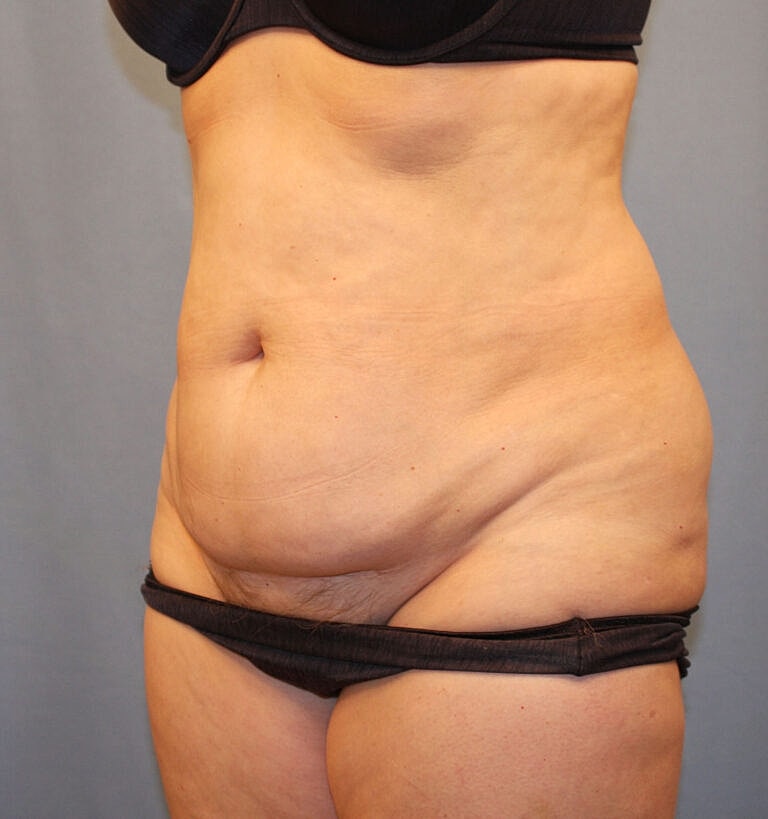 Abdominoplasty Tummy Tuck Before & After