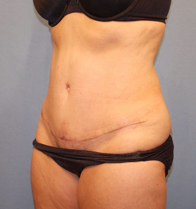 Abdominoplasty Tummy Tuck Before & After