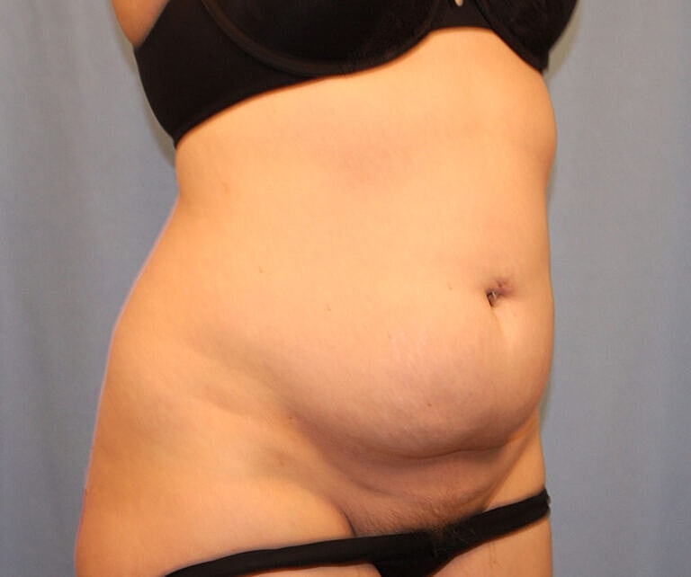 Abdominoplasty Tummy Tuck Before & After