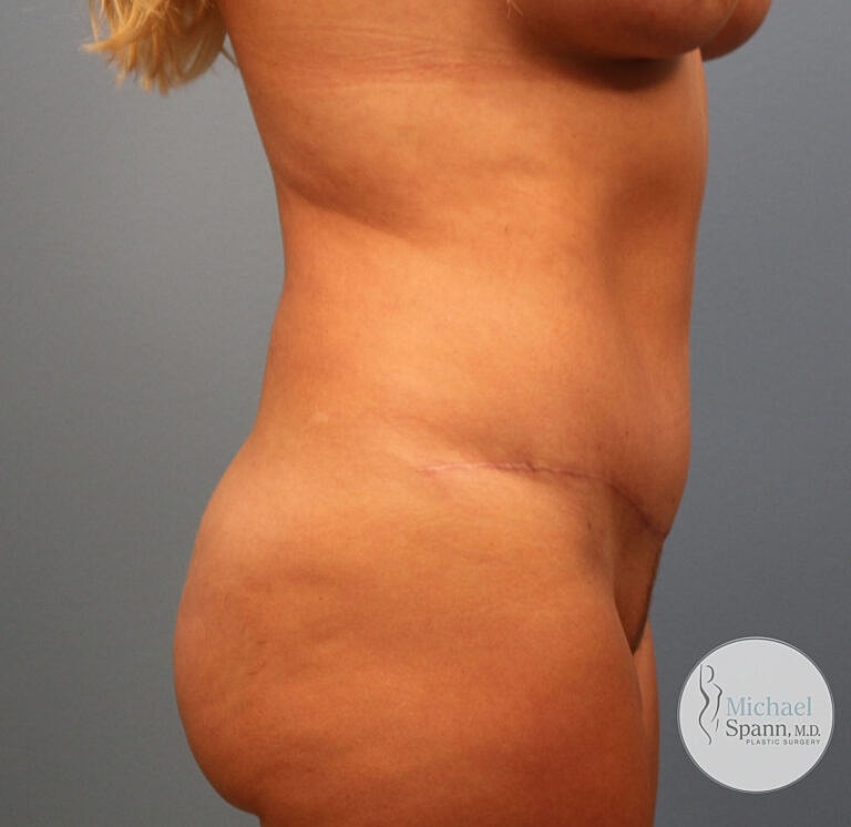 Abdominoplasty Tummy Tuck Before & After