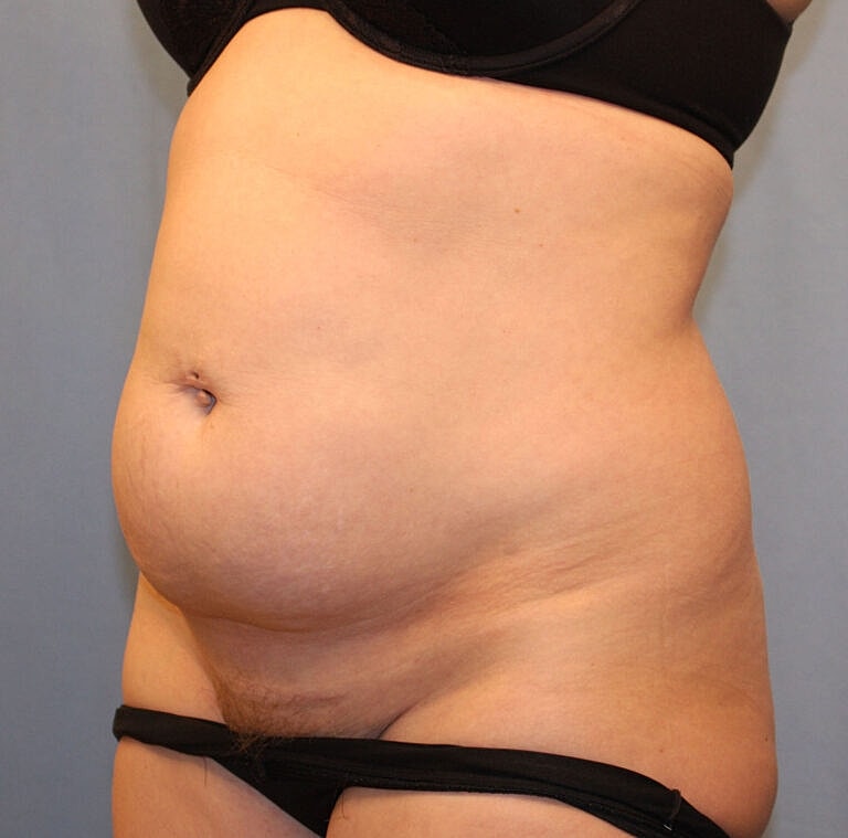 Abdominoplasty Tummy Tuck Before & After
