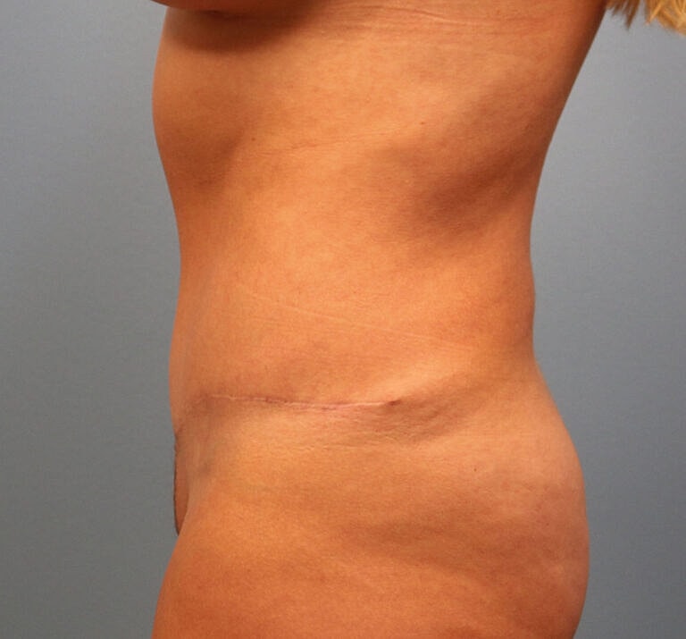 Abdominoplasty Tummy Tuck Before & After